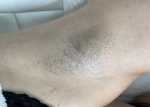 Voor laserontharen Inge van der Aa Hardenberg actie